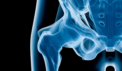 Hip-surgery-schematic