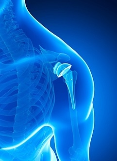 Shoulder-surgery-schematic